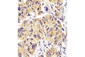 D staining PDGFRA in Human hepatic carcinoma tissue sections by Immunohistochemistry (IHC-P - paraformaldehyde-fixed, paraffin-embedded sections). (PDGFRA anticorps  (AA 698-727))