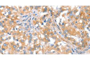 Immunohistochemistry of paraffin-embedded Human thyroid cancer tissue using ST14 Polyclonal Antibody at dilution 1:70 (ST14 anticorps)