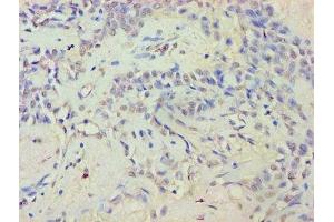 Immunohistochemistry of paraffin-embedded human breast cancer using ABIN7152359 at dilution of 1:100 (EYA2 anticorps  (AA 1-514))