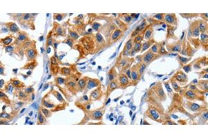 Immunohistochemistry of paraffin-embedded Human lung cancer using IGF2BP1 Polyclonal Antibody at dilution of 1:40 (IGF2BP1 anticorps)