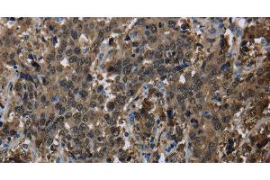 Immunohistochemistry of paraffin-embedded Human liver cancer using GSTA3 Polyclonal Antibody at dilution of 1:30
