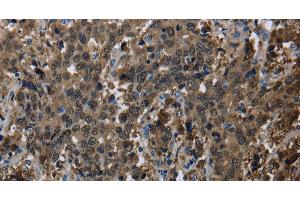 Immunohistochemistry of paraffin-embedded Human liver cancer using GSTA3 Polyclonal Antibody at dilution of 1:30 (GSTA3 anticorps)