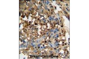 D antibody (C-term) (ABIN654936 and ABIN2844579) immunohistochemistry analysis in formalin fixed and paraffin embedded human breast carcinoma followed by peroxidase conjugation of the secondary antibody and DAB staining.