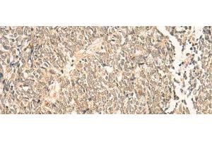 Immunohistochemistry of paraffin-embedded Human lung cancer tissue using NIP7 Polyclonal Antibody at dilution of 1:50(x200)