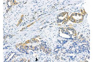 ABIN6263291 and ABIN6266590 at 1/100 staining Human lung cancer by IHC-P. (MMP11 anticorps  (N-Term))