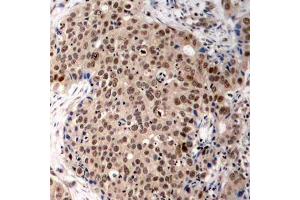 Immunohistochemistry of paraffin-embedded human breast carcinoma using Phospho-MAPKAPK2-T334 antibody (ABIN2988148). (MAPKAP Kinase 2 anticorps  (pThr334))