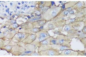 Immunohistochemistry of paraffin-embedded Human mammary cancer using CEACAM5 Monoclonal Antibody at dilution of 1:100 (40x lens).
