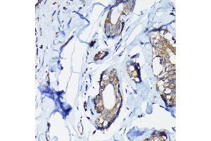 Immunohistochemistry of paraffin-embedded human breast cancer using PEG10 Rabbit pAb (ABIN3016692, ABIN3016693, ABIN1681320 and ABIN6219814) at dilution of 1:100 (40x lens).