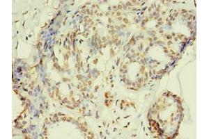 Immunohistochemistry of paraffin-embedded human breast cancer using ABIN7168449 in 30 μg/mL dilute concentrations. (RRM1 anticorps)