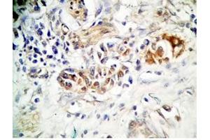 Human stomach cancer tissue was stained by rabbit anti-Spexin(H) Antiserum (Spexin anticorps)