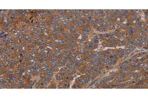 Immunohistochemistry of paraffin-embedded Human ovarian cancer using GDF2 Polyclonal Antibody at dilution of 1:40 (GDF2 anticorps)