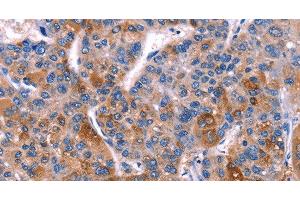 Immunohistochemistry of paraffin-embedded Human liver cancer tissue using DUSP13 Polyclonal Antibody at dilution 1:60 (DUSP13 anticorps)