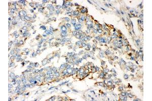 Anti- WNT2B Picoband antibody, IHC(P) IHC(P): Human Lung Cancer Tissue (WNT2B anticorps  (N-Term))