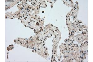 Immunohistochemical staining of paraffin-embedded Adenocarcinoma of breast tissue using anti-BUB1B mouse monoclonal antibody. (BUB1B anticorps)