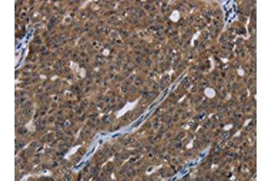 The image on the left is immunohistochemistry of paraffin-embedded Human ovarian cancer tissue using ABIN7190993(HOXC8 Antibody) at dilution 1/20, on the right is treated with synthetic peptide. (HOXC8 anticorps)