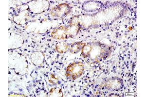 Formalin-fixed and paraffin embedded human colon carcinoma labeled with Rabbit Anti Annexin A13 Polyclonal Antibody, Unconjugated (ABIN1714416) at 1:200 followed by conjugation to the secondary antibody and DAB staining (Annexin A13 anticorps  (AA 241-316))