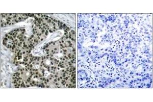 Immunohistochemistry analysis of paraffin-embedded human breast carcinoma, using HSF1 (Phospho-Ser303) Antibody. (HSF1 anticorps  (pSer303))