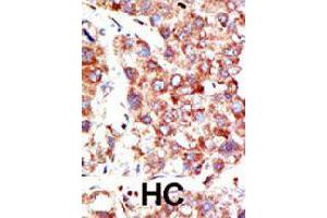 Formalin-fixed and paraffin-embedded human hepatocellular carcinoma tissue reacted with NEDD8 polyclonal antibody  , which was peroxidase-conjugated to the secondary antibody, followed by DAB staining. (NEDD8 anticorps  (N-Term))