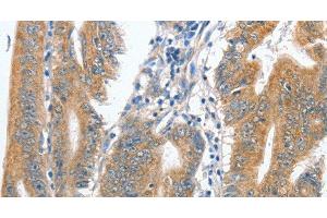 Immunohistochemistry of paraffin-embedded Human colon cancer tissue using CENPC Polyclonal Antibody at dilution 1:70 (Centromere Protein C Pseudogene 1 (CENPCP1) anticorps)