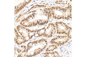 Immunohistochemistry of paraffin-embedded human colon carcinoma using TCE Rabbit mAb (ABIN7270877) at dilution of 1:25 (40x lens). (TCEA1 anticorps)