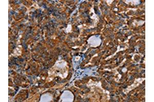 The image on the left is immunohistochemistry of paraffin-embedded Human thyroid cancer tissue using ABIN7191964(POU6F2 Antibody) at dilution 1/30, on the right is treated with synthetic peptide. (POU6F2 anticorps)
