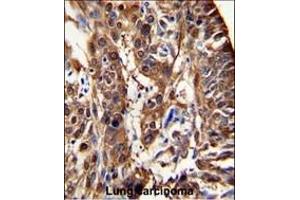 Formalin-fixed and paraffin-embedded human lung carcinoma reacted with ALDH3A1 Antibody (N-term), which was peroxidase-conjugated to the secondary antibody, followed by DAB staining.