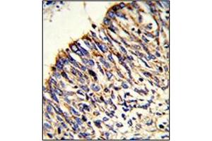 Formalin-fixed and paraffin-embedded human lung carcinoma reacted with  HADHA Antibody (C-term) followed which was peroxidase-conjugated to the secondary antibody, followed by DAB staining. (HADHA anticorps  (C-Term))