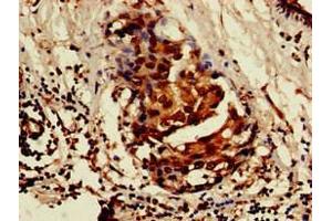 Immunohistochemistry of paraffin-embedded human breast cancer using ABIN7157103 at dilution of 1:100 (ISOC1 anticorps  (AA 155-298))