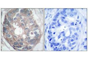 Immunohistochemical analysis of paraffin-embedded human breast carcinoma tissue using Dab1(Ab-232) Antibody(left) or the same antibody preincubated with blocking peptide(right). (DAB1 anticorps)