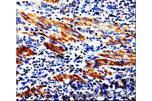 Immunohistochemistry of Human stomach cancer  using ACSBG2 Polyclonal Antibody at dilution of 1:60 (ACSBG2 anticorps)