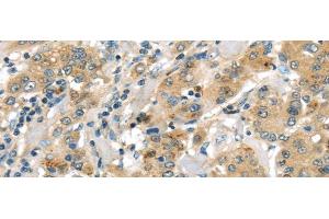 Immunohistochemistry of paraffin-embedded Human liver cancer using UTS2B Polyclonal Antibody at dilution of 1/35 (Urotensin 2B anticorps)