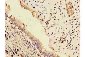 Immunohistochemistry of paraffin-embedded human lung cancer using ABIN7163357 at dilution of 1:100 (PPAP2B anticorps  (AA 144-193))