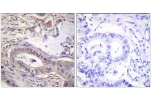 Immunohistochemistry analysis of paraffin-embedded human lung carcinoma, using BCL-XL (Phospho-Thr47) Antibody. (BCL2L1 anticorps  (pThr47))