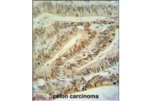 CUL5 Antibody (C-term) (ABIN391834 and ABIN2841675) immunohistochemistry analysis in formalin fixed and paraffin embedded human colon carcinoma followed by peroxidase conjugation of the secondary antibody and DAB staining. (Cullin 5 anticorps  (C-Term))