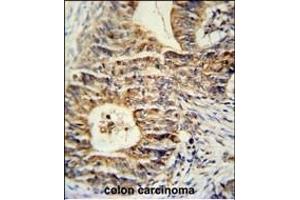 KLHL24 Antibody (Center) (ABIN651431 and ABIN2840236) immunohistochemistry analysis in formalin fixed and paraffin embedded human colon carcinoma followed by peroxidase conjugation of the secondary antibody and DAB staining. (Kelch-Like 24 anticorps  (AA 182-211))