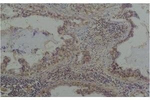 Immunohistochemistry of paraffin-embedded Human lung carcinoma tissue with Phosphoserine Monoclonal Antibody at dilution of 1:200 (Phosphoserine anticorps)