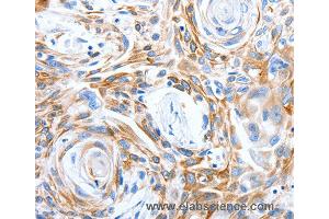 Immunohistochemistry of Human esophagus cancer using LRIG3 Polyclonal Antibody at dilution of 1:50