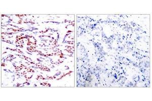 Immunohistochemical analysis of paraffin-embedded human breast carcinoma tissue using ATF2(Phospho-Thr71 or 53) Antibody(left) or the same antibody preincubated with blocking peptide(right).