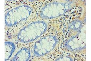 Immunohistochemistry of paraffin-embedded human colon cancer using ABIN7144823 at dilution of 1:100 (ATP5F1 anticorps  (AA 1-245))
