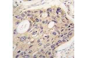 IHC analysis of FFPE human lung carcinoma tissue stained with ATG12 antibody