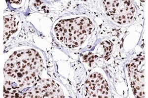 ABIN6276373 at 1/200 staining human Breast cancer tissue sections by IHC-P. (CDK4 anticorps  (Internal Region))