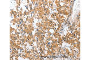 Immunohistochemistry of Human liver cancer using CHMP4B Polyclonal Antibody at dilution of 1:40 (CHMP4B anticorps)