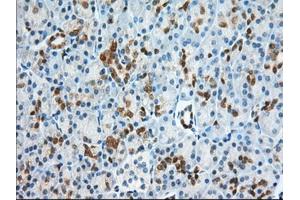 Immunohistochemical staining of paraffin-embedded Adenocarcinoma of Human ovary tissue using anti-BDH2 mouse monoclonal antibody.