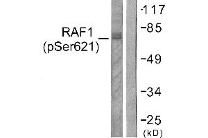 Immunohistochemistry analysis of paraffin-embedded human lung carcinoma tissue using Raf1 (Phospho-Ser621) antibody. (RAF1 anticorps  (pSer621))