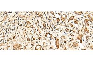 Immunohistochemistry of paraffin-embedded Human prost ate cancer tissue using SOX3 Polyclonal Antibody at dilution of 1:50(x200) (SOX3 anticorps)