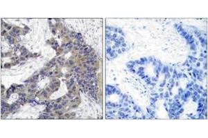 Immunohistochemistry analysis of paraffin-embedded human breast carcinoma tissue, using JAK2 (Ab-1007) Antibody. (JAK2 anticorps  (AA 981-1030))