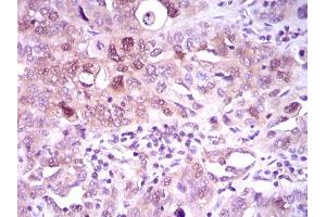 Immunohistochemical analysis of paraffin-embedded endometrial cancer tissues using ACLY mouse mAb with DAB staining.