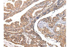 The image on the left is immunohistochemistry of paraffin-embedded Human esophagus cancer tissue using ABIN7190330(COL8A2 Antibody) at dilution 1/20, on the right is treated with synthetic peptide. (COL8a2 anticorps)