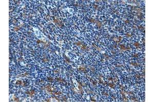 Immunohistochemical staining of paraffin-embedded Human lymphoma tissue using anti-MICAL1 mouse monoclonal antibody. (MICAL1 anticorps)