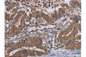 The image on the left is immunohistochemistry of paraffin-embedded Human esophagus cancer tissue using ABIN7130067(LCMT1 Antibody) at dilution 1/20, on the right is treated with fusion protein. (LCMT1 anticorps)